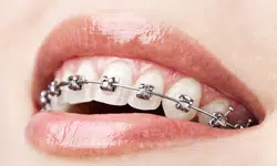 Self-ligating Braces