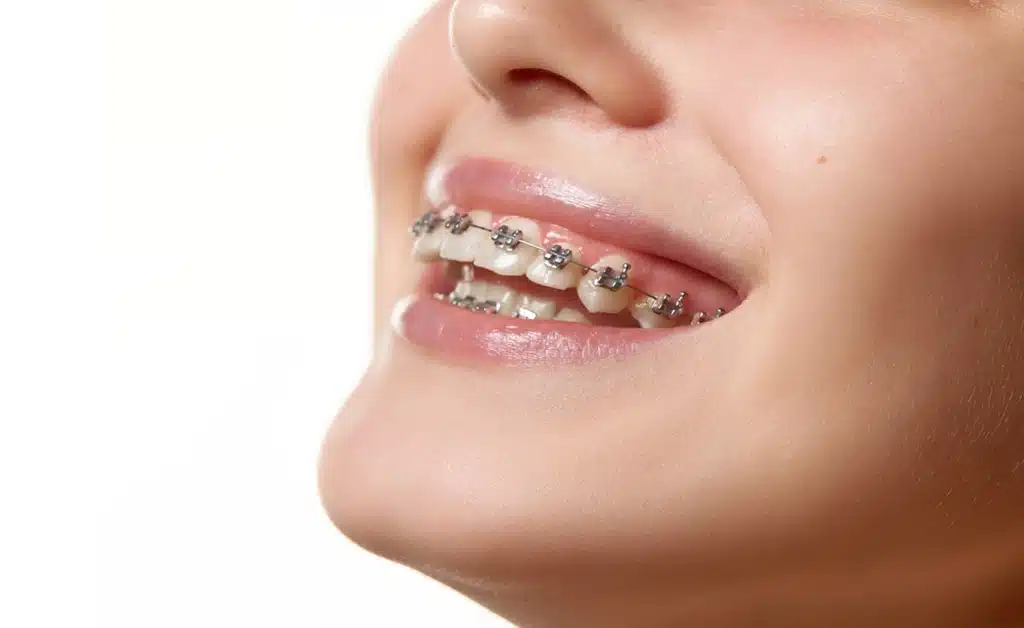 Braces Take to Straighten Teeth
